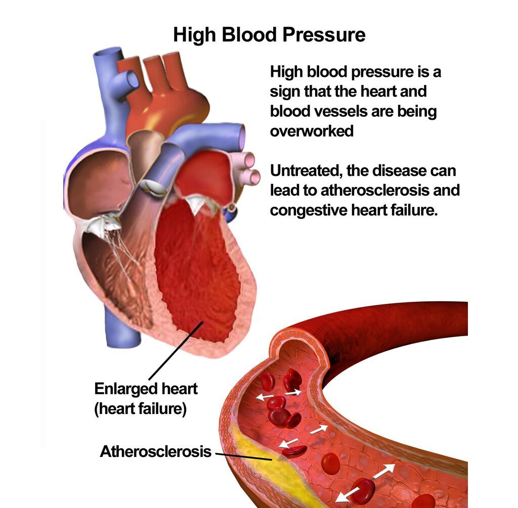 Imagen: Ilustración que muestra los efectos de la presión arterial alta (Fotografía cortesía de Wikimedia Commons)