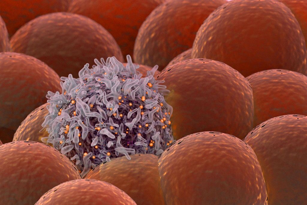 Imagen: Una célula cancerosa entre células normales. Se ha descubierto un nuevo biomarcador, la plectina, en las células madre del cáncer, que gobierna la supervivencia y la diseminación del cáncer (Fotografía cortesía de Laurie Fickman/Universidad de Houston).