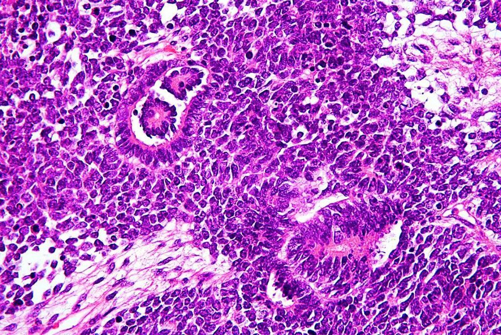Imagen: Histopatología del tumor de Wilms o nefroblastoma, que es un tipo de cáncer de riñón que se observa predominantemente en niños (Fotografía cortesía de Nephron).