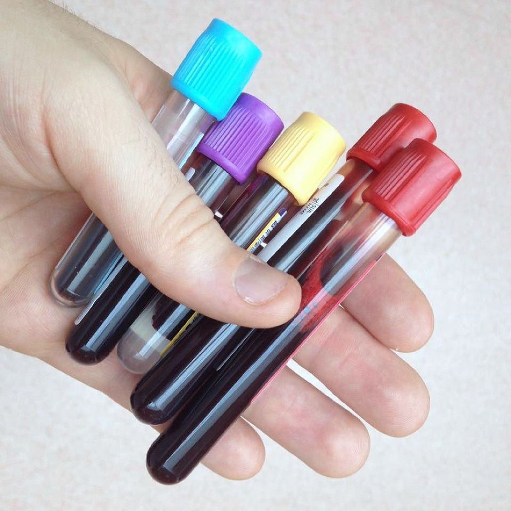 Imagen: La adiposidad en los niños afecta los marcadores bioquímicos en las muestras de sangre por (Fotografía cortesía de Photo Tom Mallinson).