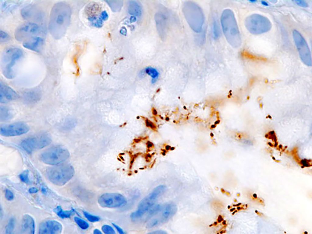 Imagen: Inmunocoloración de la infección por Helicobacter pylori en un hoyo foveolar gástrico demostrado en una biopsia gástrica endoscópica (Fotografía cortesía de KGH).
