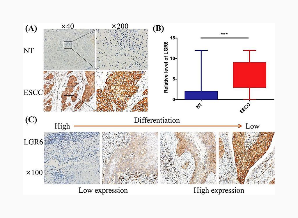 Imagen: Inmunocoloración histológica que muestra la expresión del receptor 6 acoplado a proteínas G que contiene repeticiones ricas en leucina (LGR6) en el carcinoma escamocelular de esófago (ESCC) y en tejidos esofágicos normales (NT) (Fotografía cortesía de la Universidad Médica de Fujian).