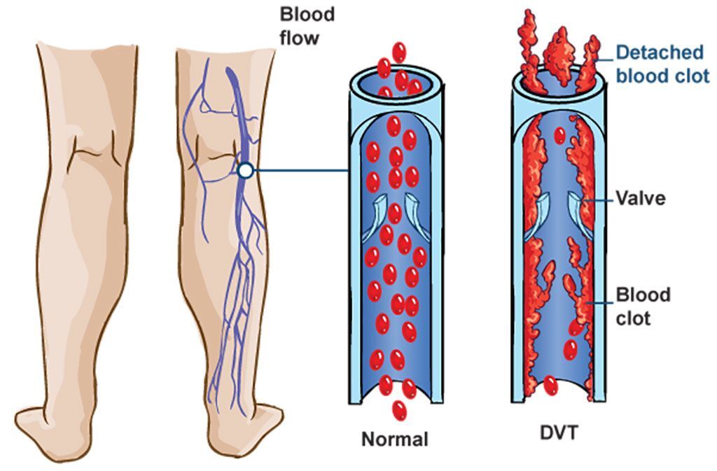 Imagen: Diagrama esquemático de la trombosis venosa profunda (TVP) asociada con el síndrome metabólico (Fotografía cortesía de MediConnect).