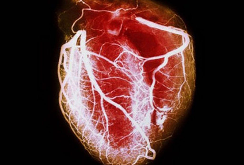 Imagen: La asociación de todo el genoma y el análisis de aleatorización mendeliana proporcionan información sobre la patogénesis de la insuficiencia cardíaca (Fotografía cortesía de WebMD).