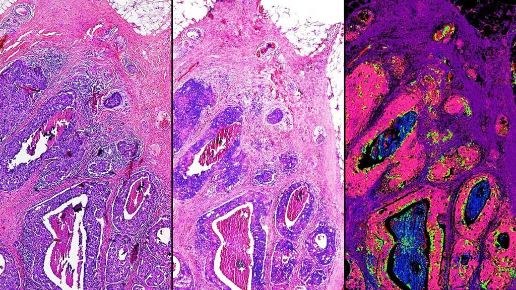 Imagen: Esta comparación lado a lado de una biopsia de tejido mamario demuestra algunas de las capacidades del microscopio híbrido óptico-infrarrojo. A la izquierda, una muestra de tejido teñida por métodos tradicionales. Centro, una coloración computarizada creada a partir de imágenes híbridas óptico-infrarrojas. Derecha, tipos de tejidos identificados con datos infrarrojos. El rosa en esta imagen significa cáncer maligno (Fotografía cortesía de Rohit Bhargava, PhD).