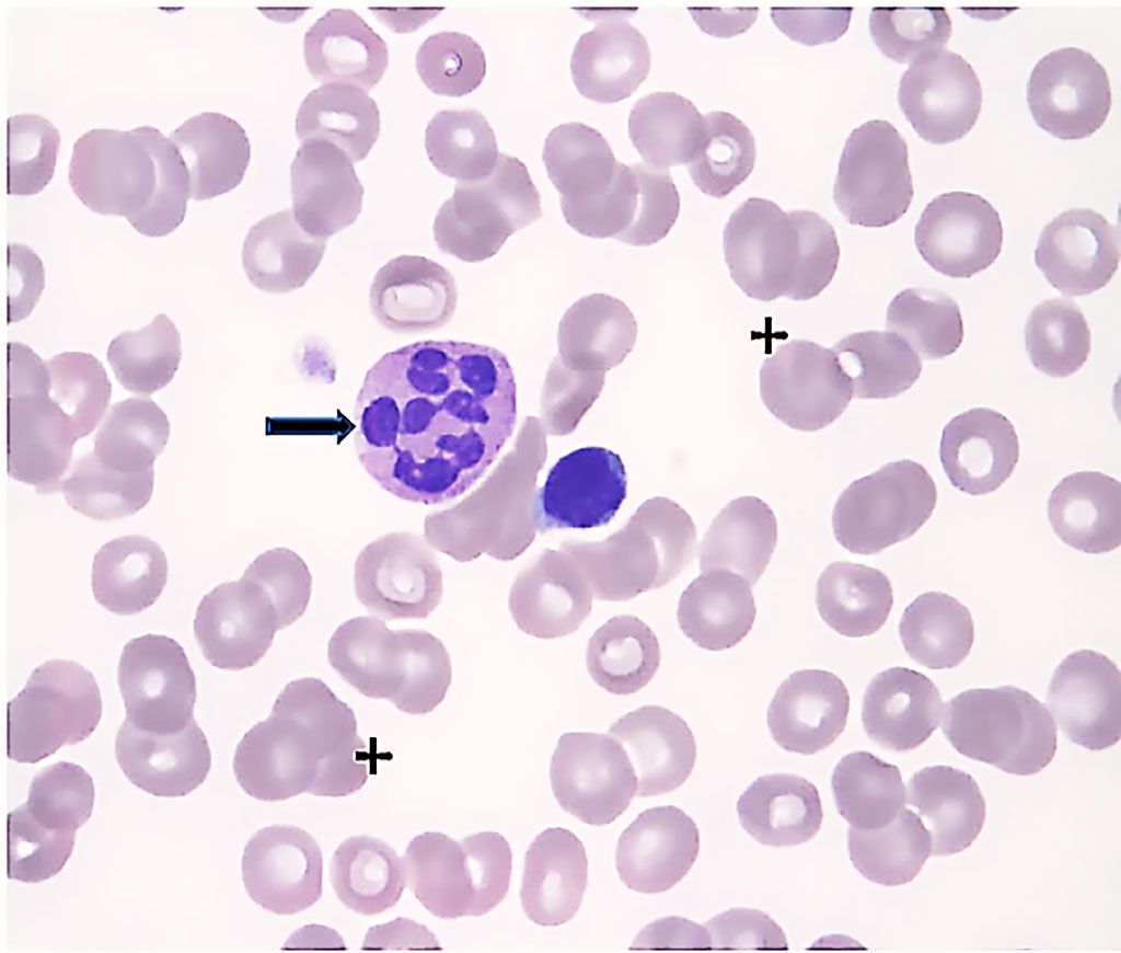 Imagen: Frotis de sangre periférica de un paciente con síndrome mielodisplásico que muestra anemia macrocítica e hipercrómica (cruzada), neutrófilos hipersegmentados (flecha) y trombocitopenia moderada (Fotografía cortesía de Jong-Hwa Kim, MD, PhD).