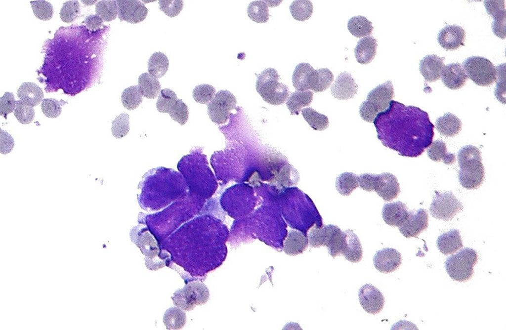 Imagen: Histopatología que muestra las características clave del carcinoma de pulmón de células pequeñas (CPCNM): moldeo nuclear; cromatina de sal y pimienta; y escaso citoplasma (Fotografía cortesía de Nephron).