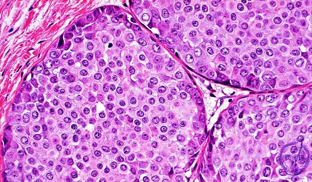 Imagen: Histopatología de un tejido mamario con cáncer; las células tumorales han proliferado en un patrón cerrado sin formación tubular. Este tumor representa un carcinoma ductal moderadamente diferenciado (Fotografía cortesía de la Sociedad Japonesa de Patología).