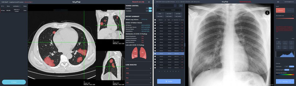 Imagen: VUNO Med-LungQuant y VUNO Med-Chest X-ray (Fotografía cortesía de VUNO) Imagen: VUNO Med-LungQuant y VUNO Med-Chest X-ray (Fotografía cortesía de VUNO)