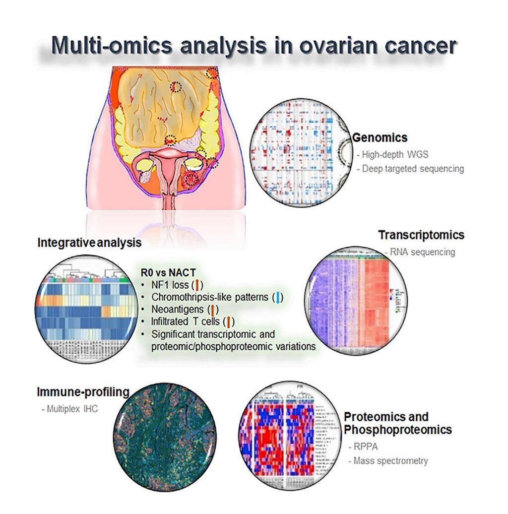 Imagen: Diagrama esquemático del análisis molecular de subconjuntos clínicamente definidos de cáncer de ovario seroso de alto grado (Fotografía cortesía del Centro de Cáncer MD Anderson).