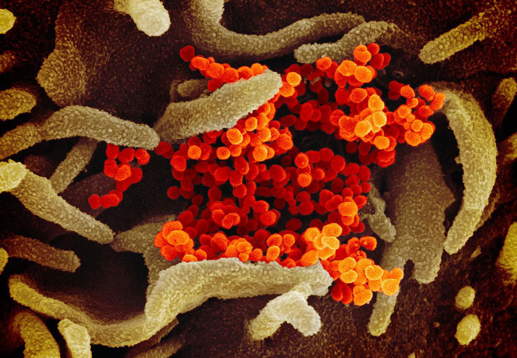 Imagen: Una imagen de microscopio electrónico de barrido del SARS-CoV-2 (Fotografía cortesía del NIAID-RML) Imagen: Una imagen de microscopio electrónico de barrido del SARS-CoV-2 (Fotografía cortesía del NIAID-RML)
