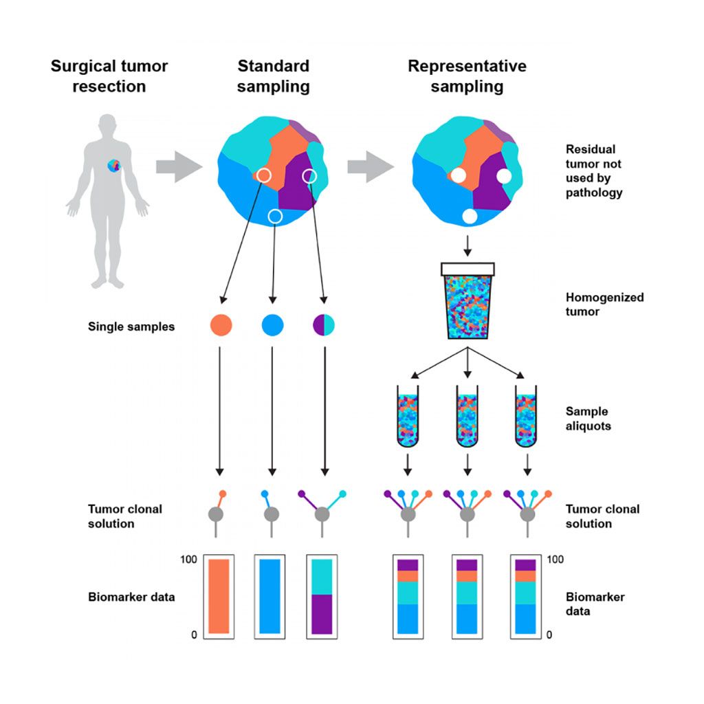 Imagen: Diagrama esquemático de cómo el método de muestreo representativo de tumores disminuye el sesgo en los análisis moleculares (Fotografía cortesía del Instituto Francis Crick).