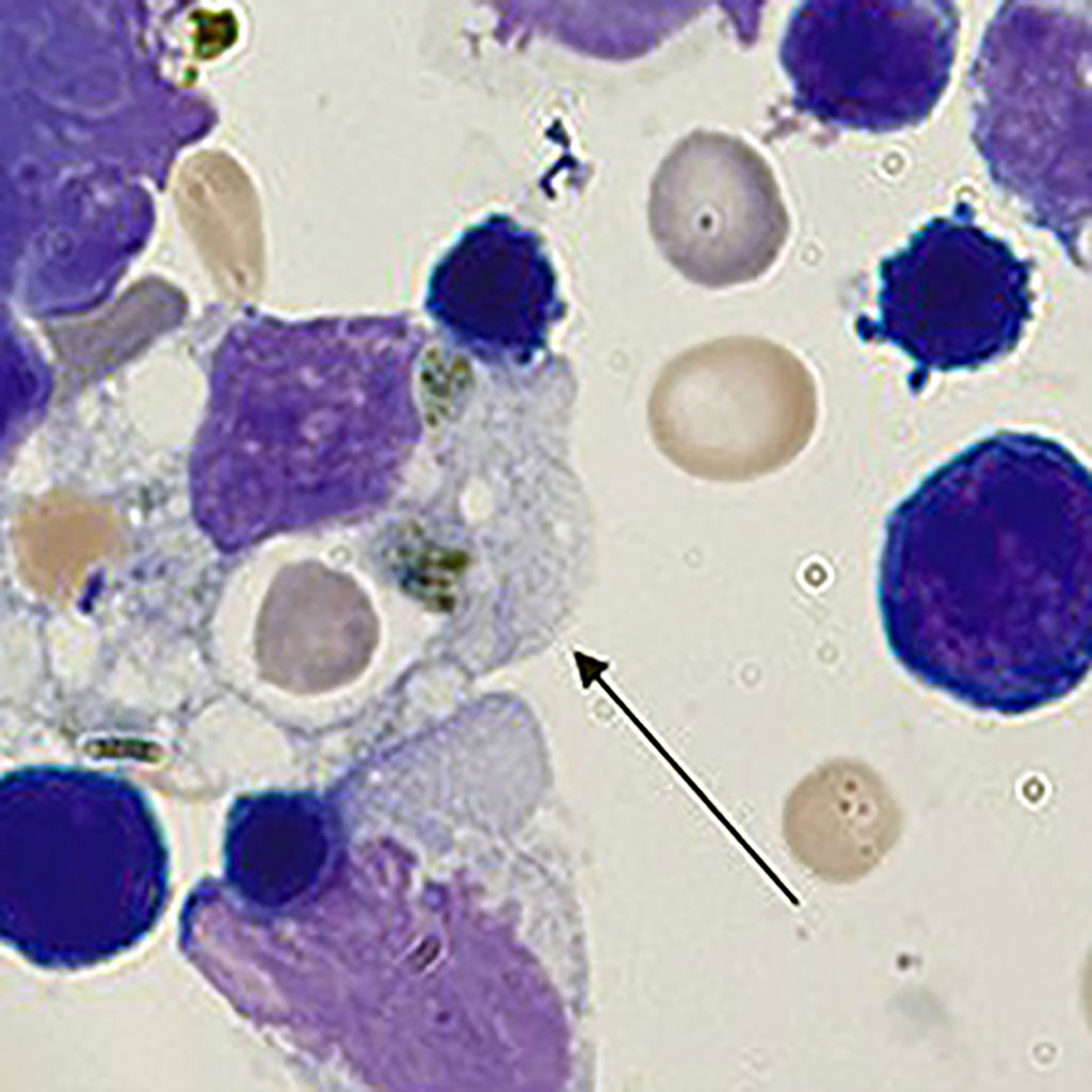 Imagen: Esta es una fotografía microscópica de un frotis de sangre de un ratón transgénico que imita el trastorno inmunitario humano, HLH secundario (Fotografía cortesía del Centro Médico del Hospital Infantil de Cincinnati) Imagen: Esta es una fotografía microscópica de un frotis de sangre de un ratón transgénico que imita el trastorno inmunitario humano, HLH secundario (Fotografía cortesía del Centro Médico del Hospital Infantil de Cincinnati)