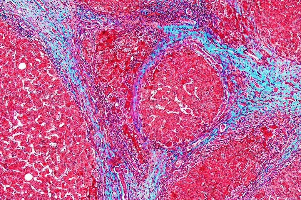 Imagen: Microfotografía de gran aumento de un hígado con cirrosis (Fotografía cortesía de Nephron).