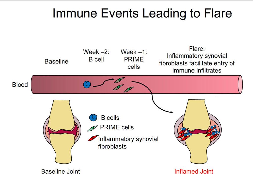 Imagen: Eventos inmunes que conducen a una exacerbación de la artritis reumatoide (Fotografía cortesía de la Dra. Dana Orange, Universidad Rockefeller)
