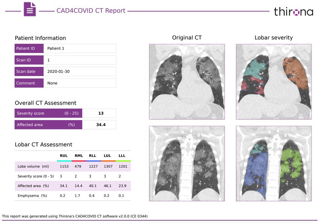 Imagen: Una muestra de un informe CAD4COVID-CT (Fotografía cortesía de Thirona) Imagen: Una muestra de un informe CAD4COVID-CT (Fotografía cortesía de Thirona)