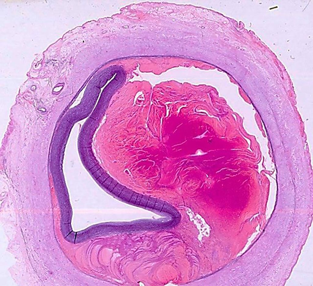 Imagen: Histopatología de la arteria coronaria mostrando un hematoma intramural que comprime la luz del vaso desde el exterior de un paciente con disección espontánea de la arteria coronaria (Fotografía cortesía de la profesora Mary N Sheppard, MBBCh FRCPath).