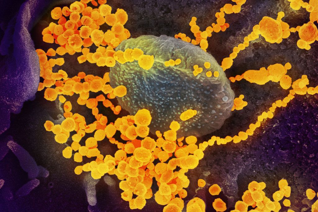 Imagen: Imagen tomada con un microscopio electrónico de barrido (SEM) que muestra el SARS-CoV-2 (objetos redondos dorados) que emergen de la superficie de células cultivadas en el laboratorio (Fotografía cortesía del Instituto Nacional de Alergias y Enfermedades Infecciosas [EUA])