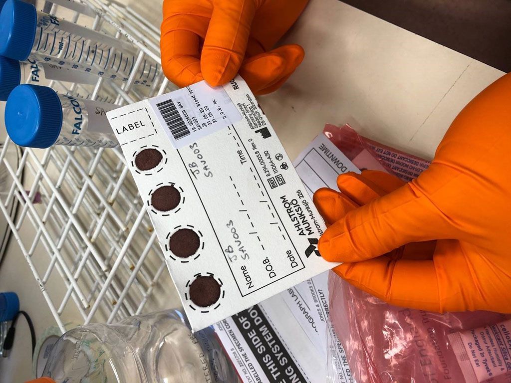 Imagen: El muestreo de muestras de sangre seca es simple, económico y el paciente puede recolectarlo personalmente en casa, con un simple pinchazo en el dedo (Fotografía cortesía de la Universidad de Birmingham)
