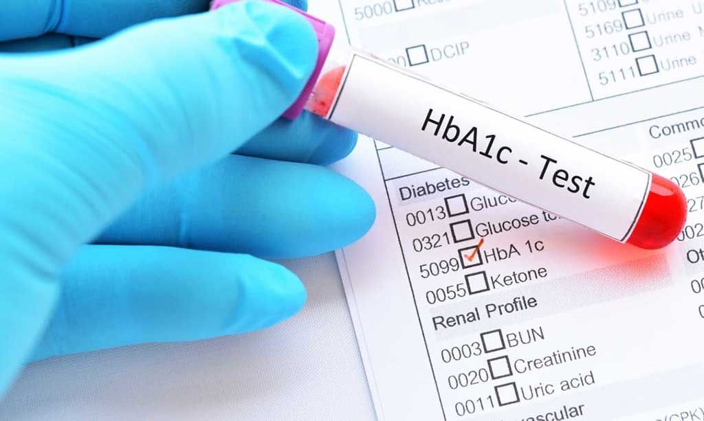 Imagen: La prueba de cribado de hemoglobina glucosilada (HbA1c) revela diabetes no diagnosticada (Fotografía cortesía de Diabetes.co.uk).