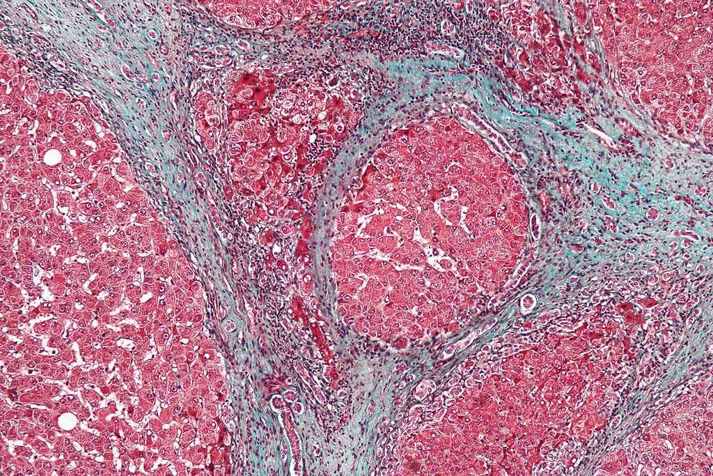 Imagen: Microfotografía que muestra la fibrosis del hígado causada por cirrosis. El tejido de este ejemplo se tiñe con una coloración tricrómica, en la que la fibrosis es de color azul. Las áreas rojas son el tejido hepático nodular (Fotografía cortesía de Wikimedia Commons)
