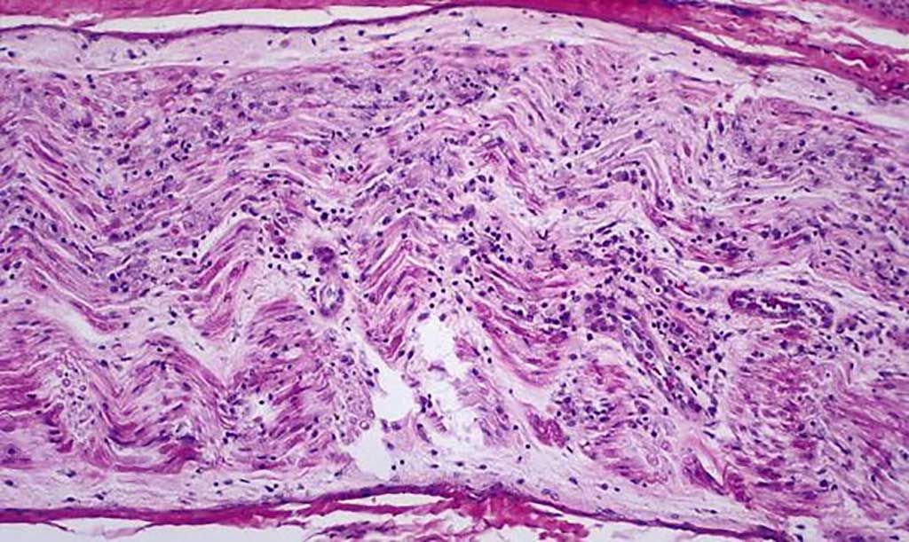 Imagen: Histopatología del síndrome de Guillain-Barré: inflamación en el nervio periférico (Fotografía cortesía de Dimitri P. Agamanolis, MD).