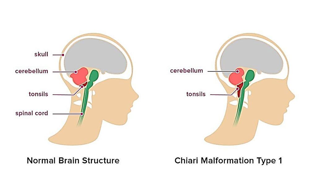 Imagen: Representación esquemática de la malformación de Chiari tipo 1; involucra la parte inferior del cerebelo conocida como amígdalas, pero no el tallo cerebral (Fotografía cortesía de Healthline).