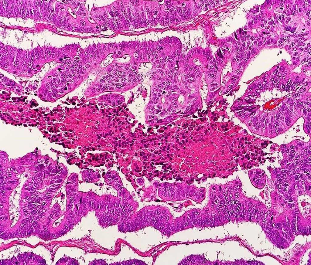 Imagen: Microfotografía de un carcinoma colorrectal moderadamente diferenciado con necrosis sucia (Fotografía cortesía de Mikael Häggström, MD).