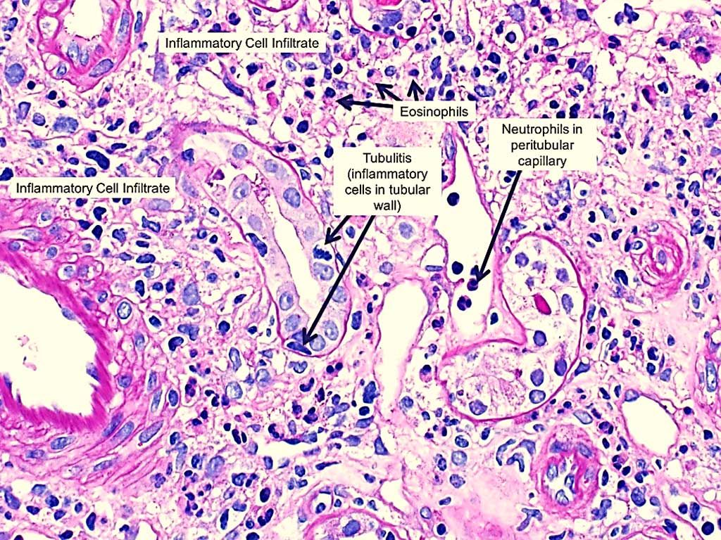 Imagen: Histopatología de la nefritis intersticial aguda inducida por fármacos que muestra inflamación intersticial con eosinófilos prominentes y tubulitis (la presencia de células inflamatorias dentro de la pared tubular) (Fotografía cortesía de NephSim).