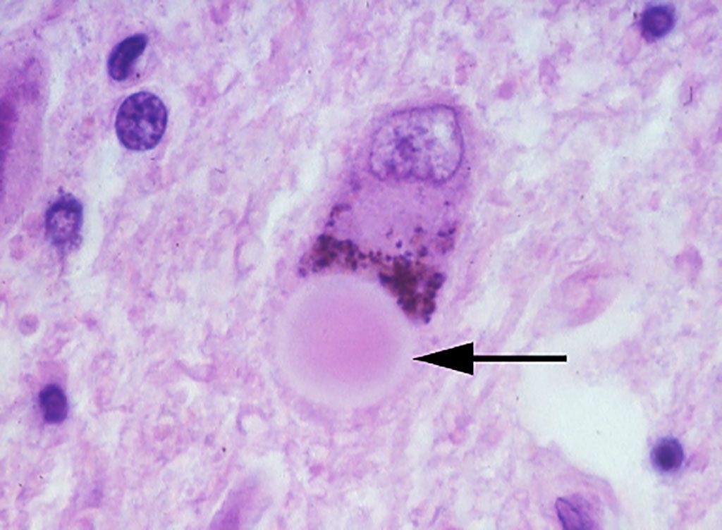 Imagen: Histopatología de cuerpos de Lewy en el mesencéfalo. Un cuerpo de Lewy en una neurona melanizada de la sustancia negra. El cuerpo de Lewy es el cuerpo esférico señalado por la flecha (Fotografía cortesía de la Dra. Susan Daniel).
