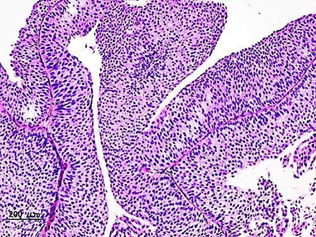 Imagen: Histopatología de una biopsia transuretral de carcinoma urotelial de la vejiga urinaria (Fotografía cortesía de KGH)