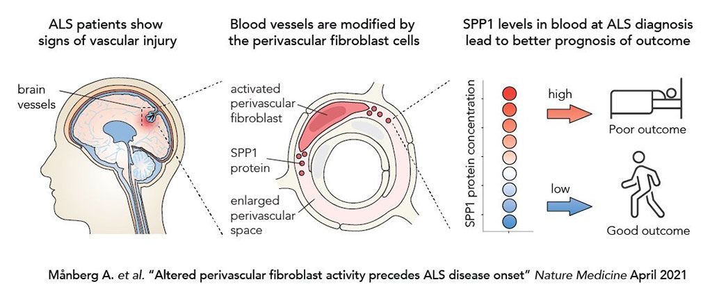 Imagen: La alteración en la actividad de los fibroblastos perivasculares precede al inicio de la esclerosis lateral amiotrófica (Fotografía cortesía de Karolinska Institutet)