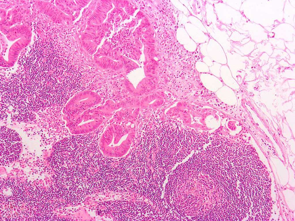 Imagen: Microfotografía de una metástasis de adenocarcinoma colorrectal a un ganglio linfático. El cáncer (glándulas formadoras) se ve en la parte superior central. El tejido adiposo está presente en la parte superior derecha (Foto cortesía de Wikimedia Commons)