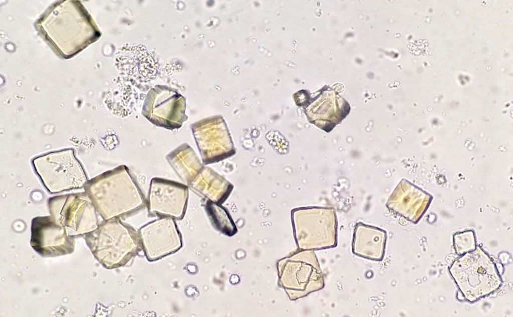 Imagen: Microfotografía de cristales de ácido úrico en el sedimento de orina (Fotografía cortesía de cannablysss)