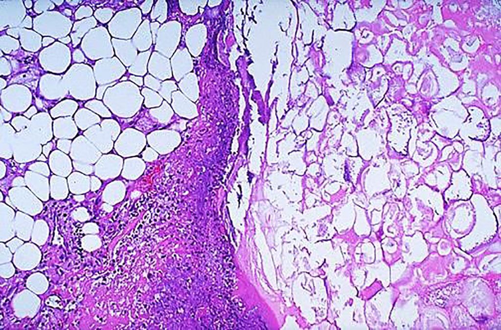 Imagen: Histología de la pancreatitis aguda. Microscópicamente, la necrosis grasa consiste en esteatocitos (adipocitos) que han perdido su núcleo y cuyo citoplasma tiene una apariencia rosada granular como se ve a la derecha. Se observa algo de hemorragia a la izquierda en este caso de pancreatitis aguda (Fotografía cortesía de la Universidad Texas A&M)