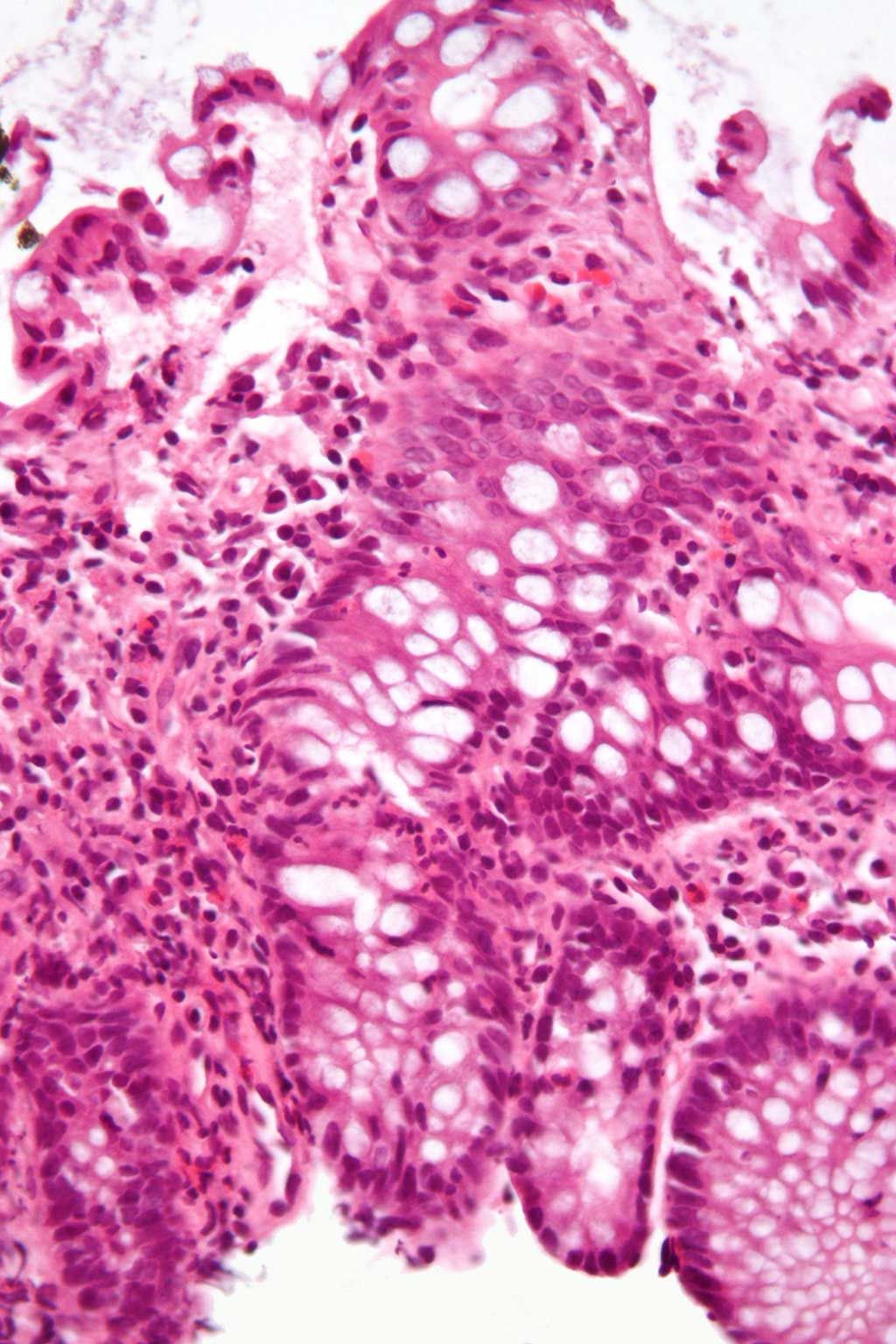 Imagen: Microfotografía que muestra la inflamación del intestino grueso en un caso de enfermedad inflamatoria intestinal (Fotografía cortesía de Wikimedia Commons)