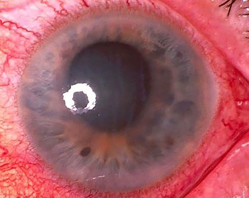 Imagen: El glaucoma primario de ángulo cerrado puede causar ceguera permanente si no se trata rápidamente. Se ha desarrollado una prueba genética de alta sensibilidad (Fotografía cortesía de la Universidad de Flinders)