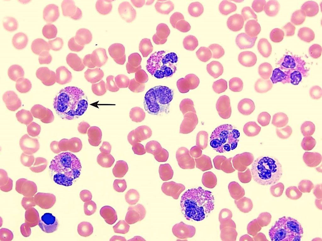 Imagen: Extendido de sangre que muestra leucocitos eosinofílicos (una sola célula con flechas) rodeados de glóbulos rojos. Aproximadamente el 50% de las personas con asma grave pueden tener niveles elevados de eosinófilos en la sangre (Fotografía cortesía de Jane Liesveld, MD)