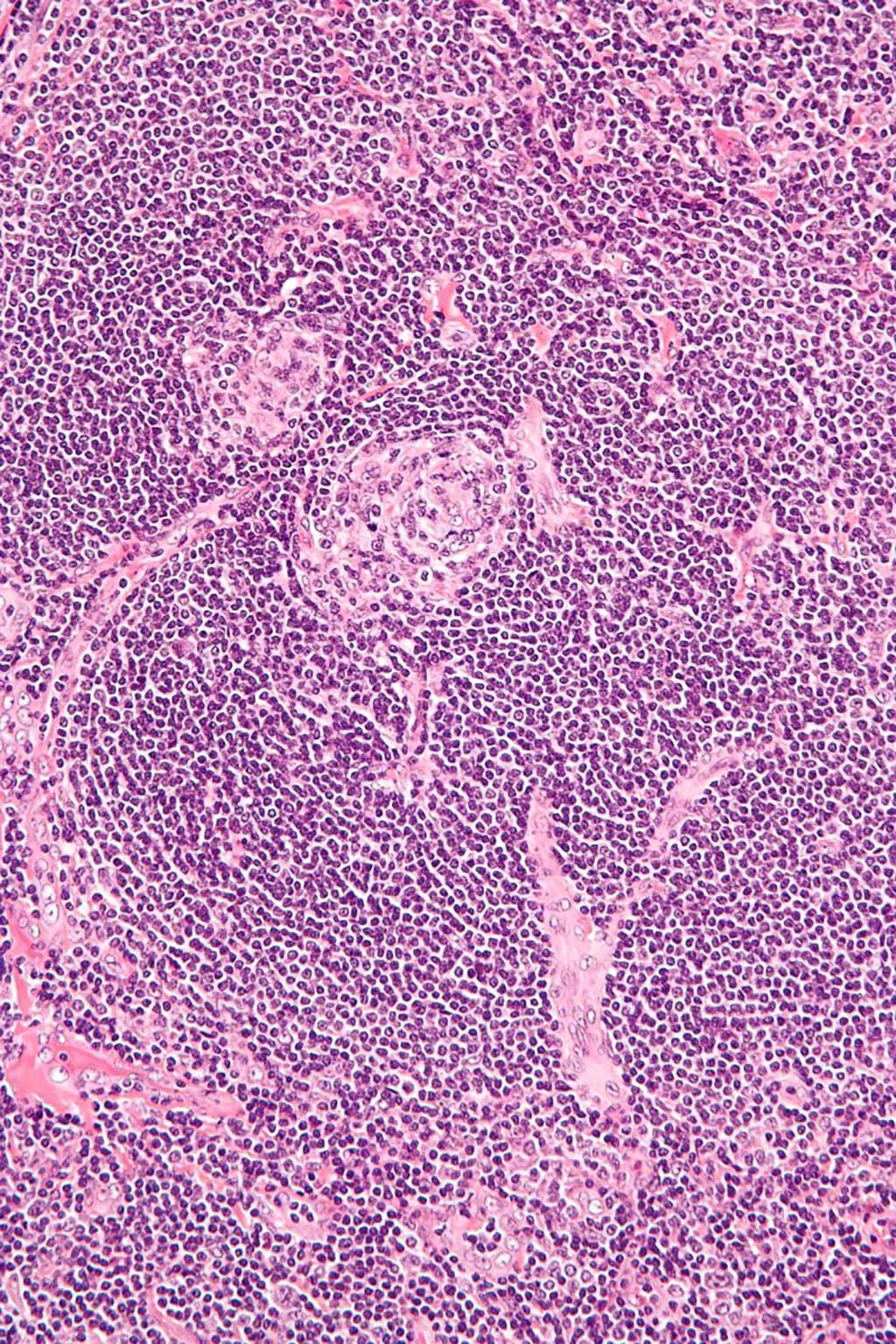 Imagen: Microfotografía de gran aumento de la enfermedad de Castleman, variante vascular hialina, también conocida como hiperplasia de ganglio linfático angiofolicular e hiperplasia de ganglio linfático gigante (Fotografía cortesía de Wikimedia Commons)