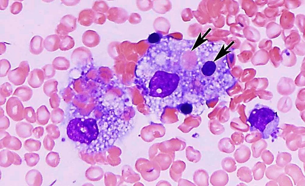 Imagen: Microfotografía de un frotis de médula ósea de un paciente con linfohistiocitosis hemofagocítica, que muestra macrófagos espumosos que engullen eritrocitos maduros y precursores (flecha) (Fotografía cortesía de Ismail Hader, MD, FACP)