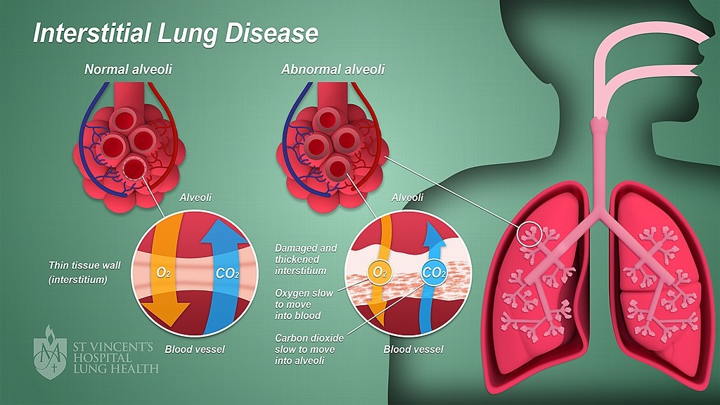 La enfermedad pulmonar intersticial afecta el flujo de gas en los alvéolos (Cortesía de: Wikimedia Commons)
