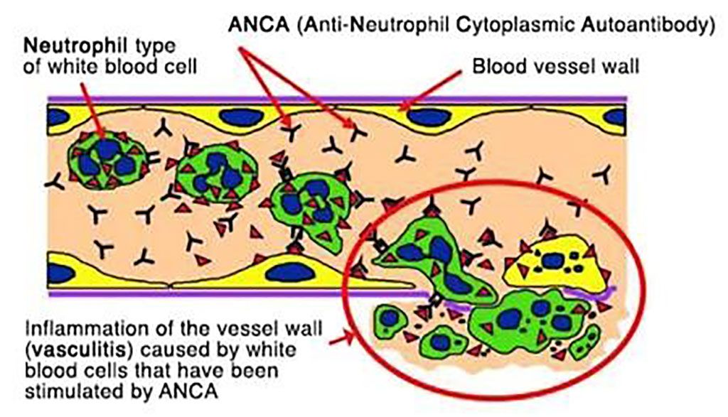 Imagen: Diagrama esquemático que muestra la “activación” de neutrófilos inducida por ANCA de anticuerpos anticitoplasma de neutrófilos que provocan inflamación de la pared de los vasos sanguíneos (Fotografía cortesía del Hospital de Addenbrooke)