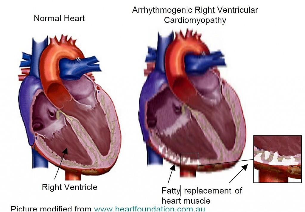Imagen: La miocardiopatía arritmogénica del ventrículo derecho (ARVC) es causada por la acumulación de depósitos de grasa y tejido fibroso en el ventrículo derecho, la cámara del corazón que bombea sangre a los pulmones (Fotografía cortesía de la Fundación Nacional del Corazón de Australia).