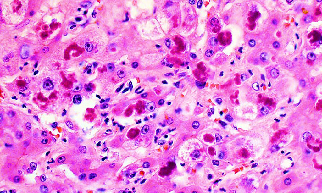 Imagen: La histopatología muestra un daño extenso en las células hepáticas como resultado de la hepatitis alcohólica (Fotografía cortesía de la Universidad Johns Hopkins)