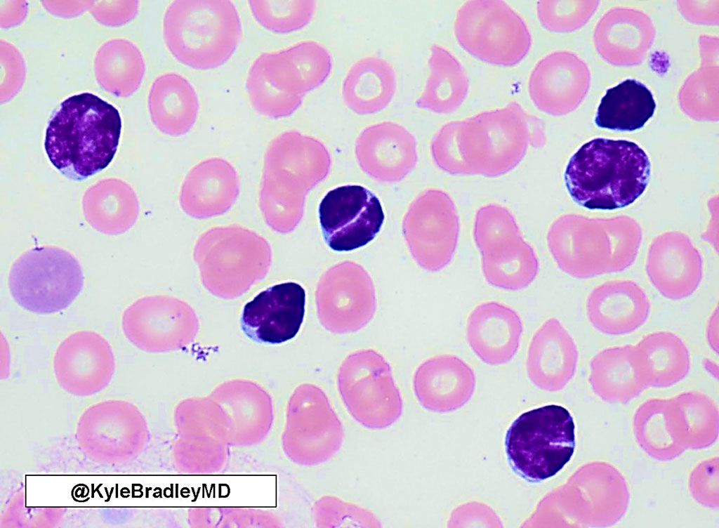 Imagen: Frotis de sangre de un paciente con linfoma folicular de bajo grado en fase leucémica: nótese los núcleos escindidos (células de granos de café) y escaso citoplasma (Fotografía cortesía de Kyle Bradley, MD)