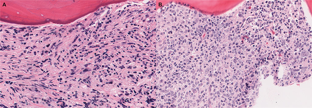 Imagen: Células altamente atípicas en médula examinada para la transformación de células grandes. Biopsias del núcleo de la médula ósea que demuestran (A) células altamente atípicas, incluidas las células con un núcleo fusiforme prominente y (B) células con marcado pleomorfismo y/o multinucleación (Fotografía cortesía de Yale Medicine)