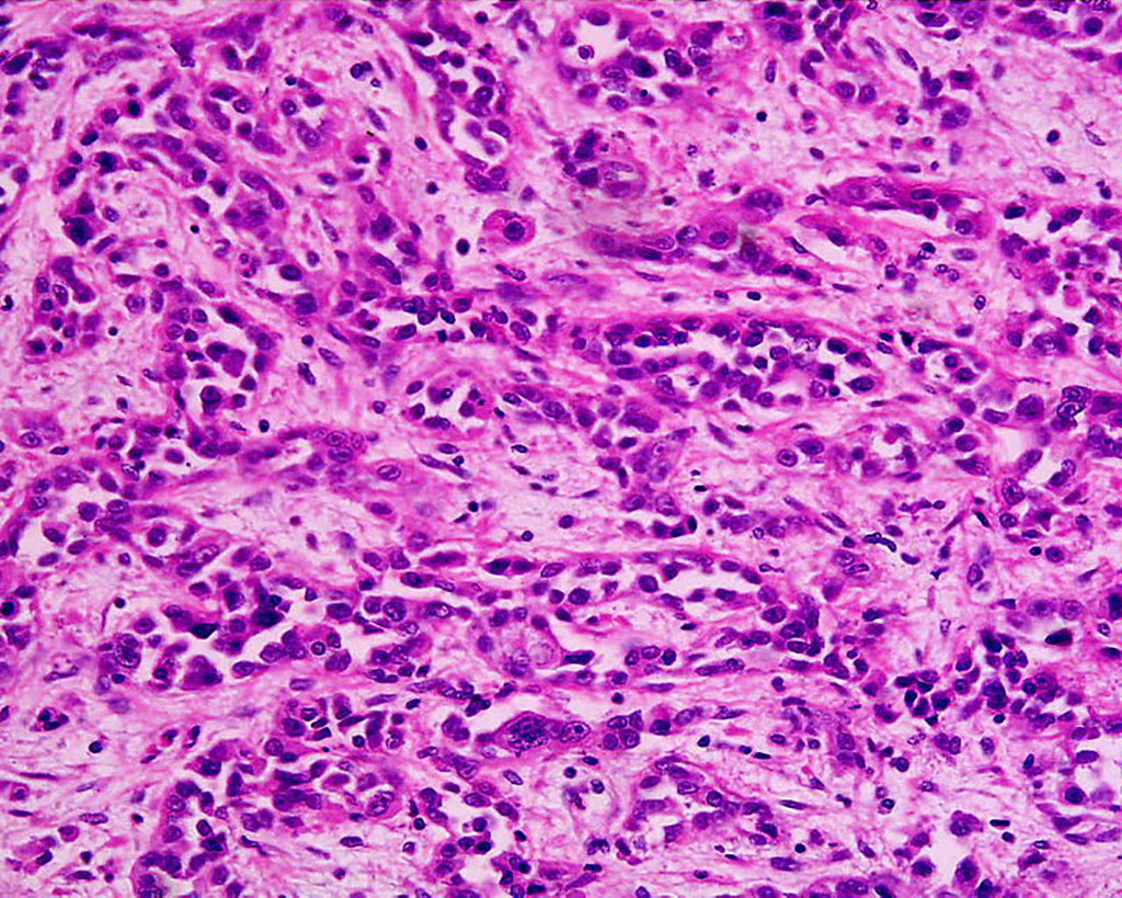 Imagen: Microfotografía de un adenocarcinoma de estómago pobre a moderadamente diferenciado (Fotografía cortesía de Wikimedia Commons) Imagen: Microfotografía de un adenocarcinoma de estómago pobre a moderadamente diferenciado (Fotografía cortesía de Wikimedia Commons)