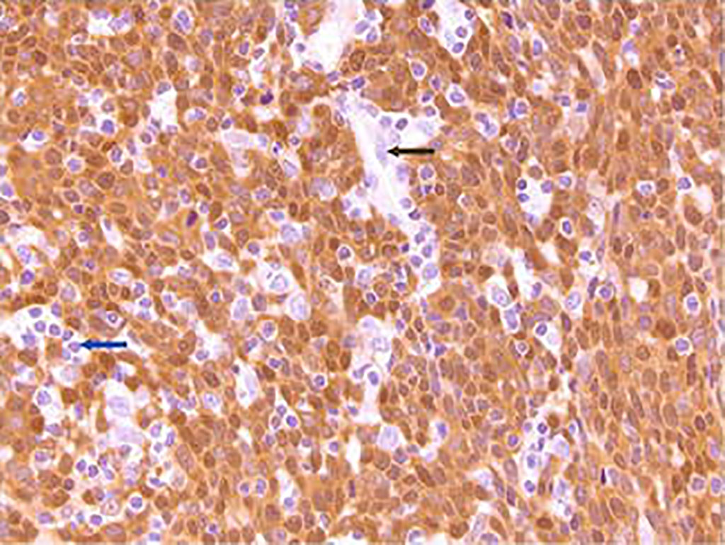 Imagen: Fuerte coloración nuclear y citoplasmática de p16 de un corte de un tumor de orofaringe VPH+. Los linfocitos (flecha azul) y las células endoteliales (flecha negra) no están coloreados (Fotografía cortesía de Jonathon McHugh, MD). Imagen: Fuerte coloración nuclear y citoplasmática de p16 de un corte de un tumor de orofaringe VPH+. Los linfocitos (flecha azul) y las células endoteliales (flecha negra) no están coloreados (Fotografía cortesía de Jonathon McHugh, MD).