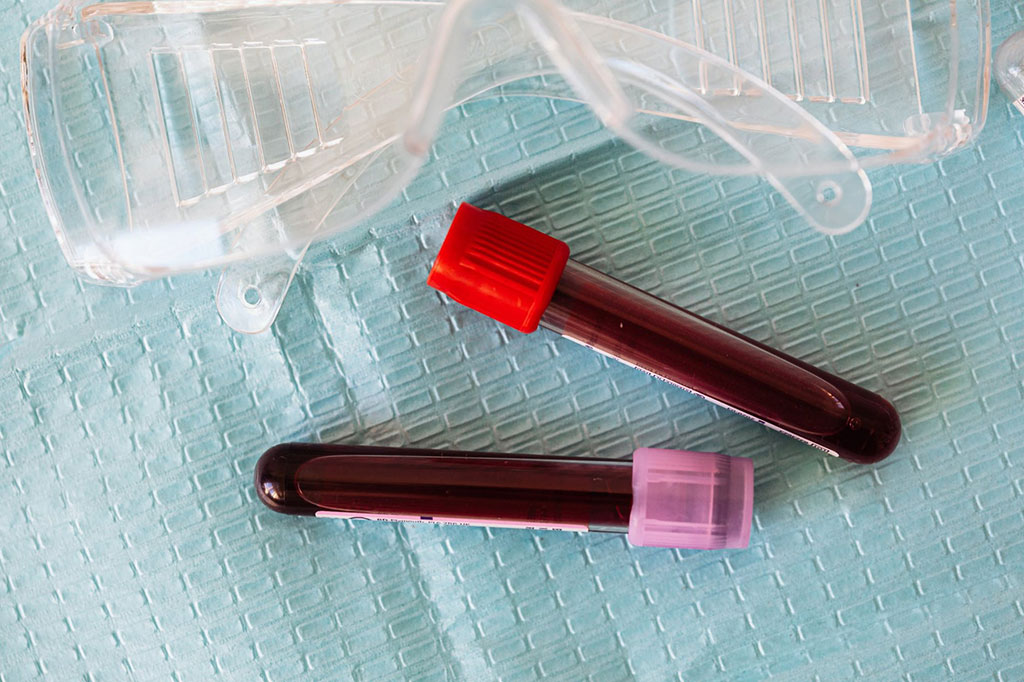 Imagen: La detección de biomarcadores en plasma podría mejorar la precisión del diagnóstico de la enfermedad de Alzheimer (Fotografía cortesía de Pexels) Imagen: La detección de biomarcadores en plasma podría mejorar la precisión del diagnóstico de la enfermedad de Alzheimer (Fotografía cortesía de Pexels)