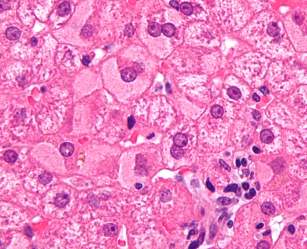 Imagen: Biopsia de hígado: microfotografía de gran aumento de hepatocitos en vidrio esmerilado, como se ve en una infección crónica por hepatitis B con una alta carga viral (Fotografía cortesía de Nephron)